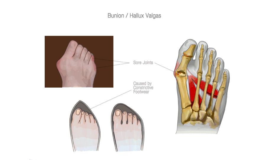 a nagy lábujj kezelési műtét arthrosis magyar kezelés